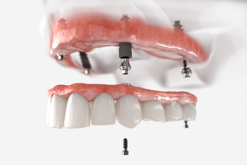 a full mouth dental implant model that shows how full mouth dental implants benefit patient's smiles because they use dental implants to secure the prosthesis.