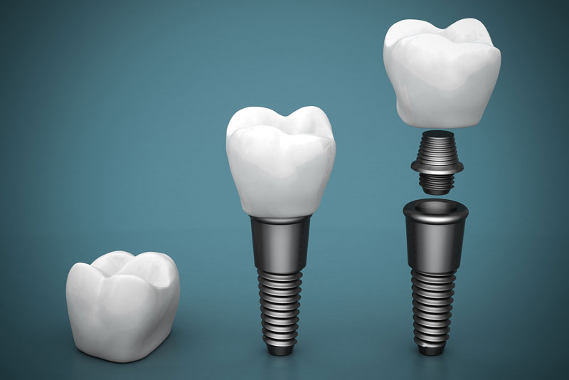 Are There Benefits To Getting Treated With Dental Implants In St. Louis, MO?