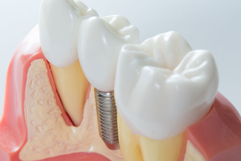 What Happens If I Don’t Have A Bone Grafting Procedure Before My Dental Implants Are Placed?
