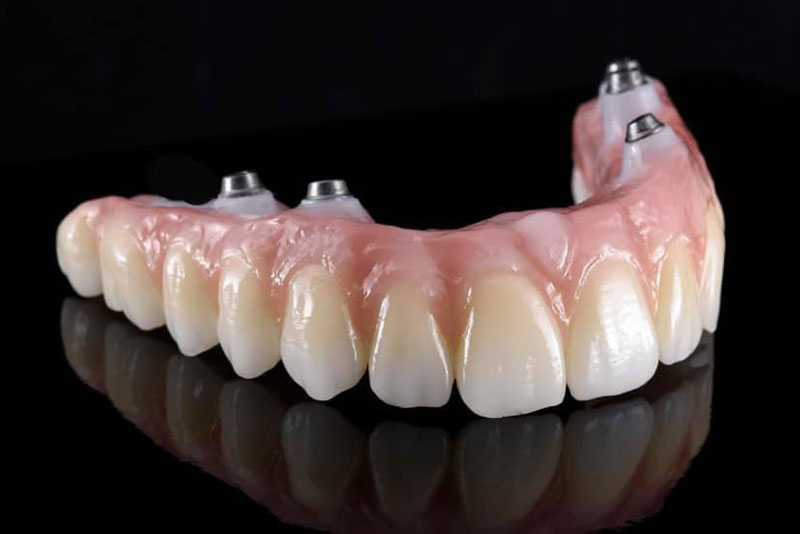 Why Should I Consider Getting Treated With Zirconia Full Arch Replacements In St. Louis, MO?