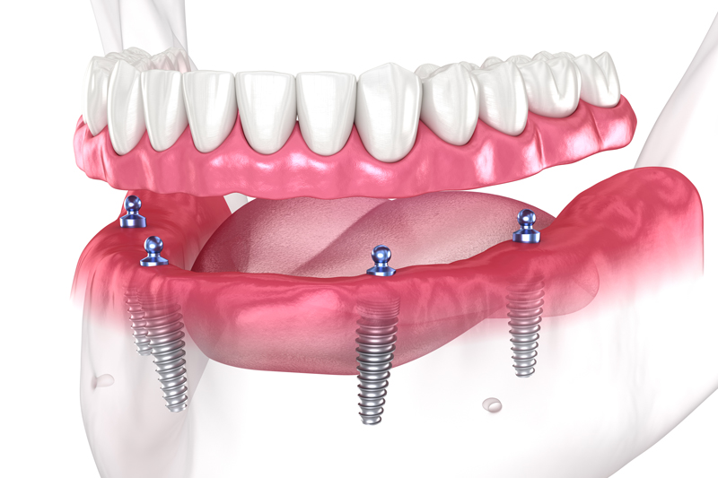 Close-up 3d image of a dental implant