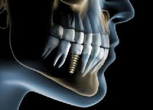 How Do I Get Full Mouth Dental Implants In St. Louis, MO Placed?