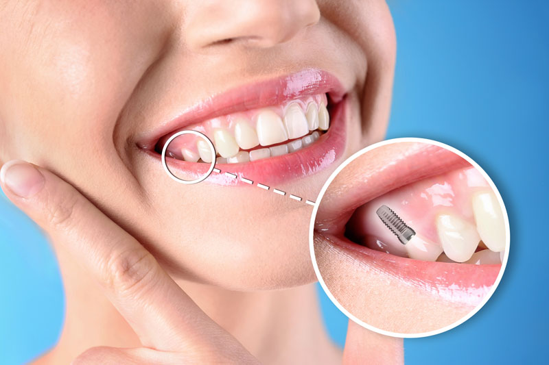 Am I Going To Benefit From Full Mouth Dental Implants In St. Louis, MO?